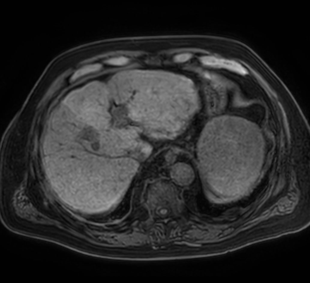Axial T1w mDIXON XD (Water only)