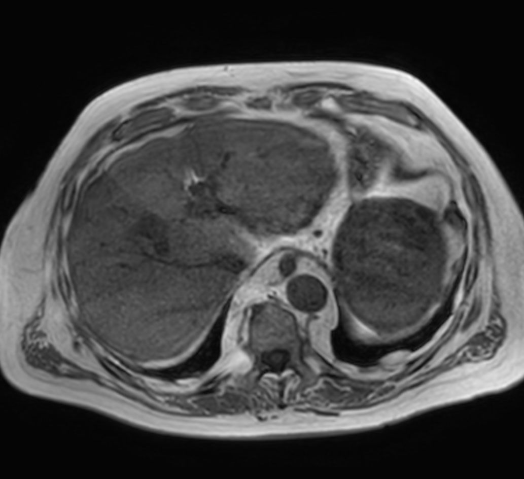 Axial T1w mDIXON XD (In Phase)