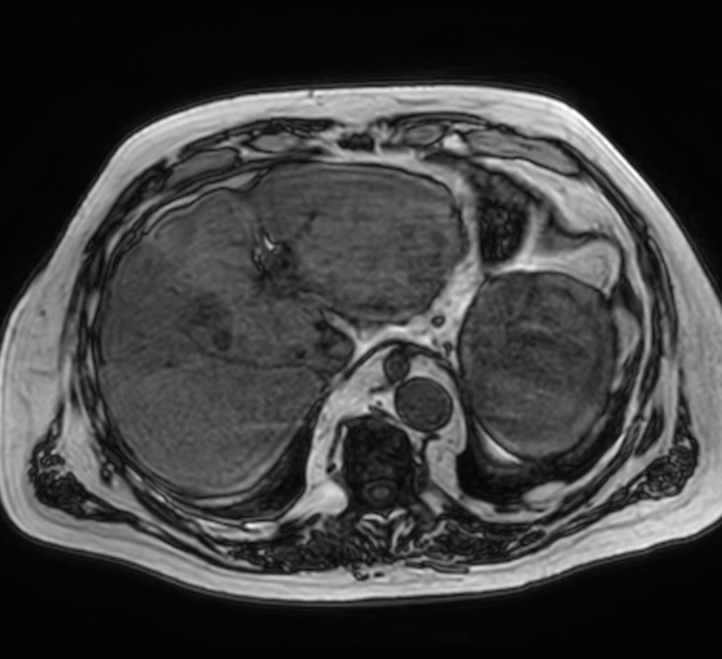 Axial T1w mDIXON XD (Out Phase)