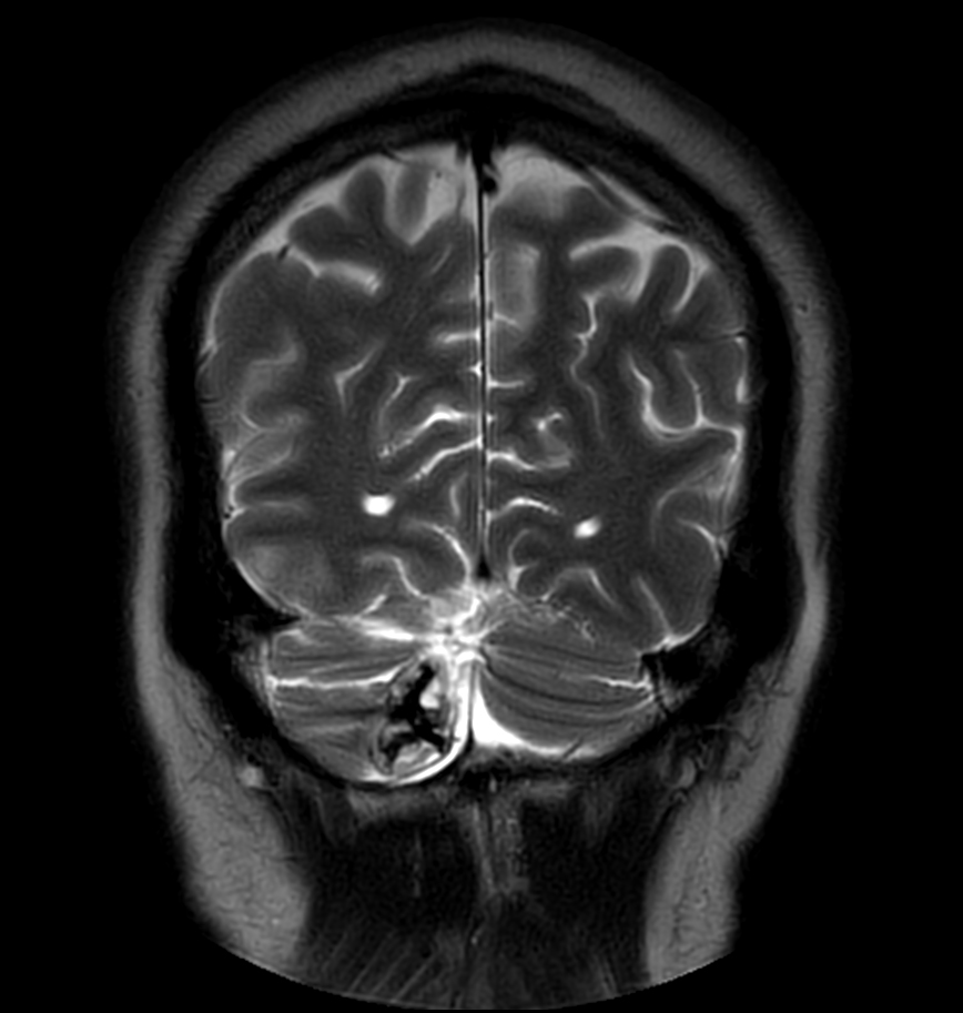 T2w TSE MultiVane XD