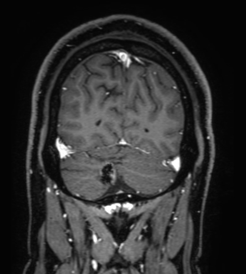 3D T1w FFE FatSat post-gado <b>Compressed SENSE</b>