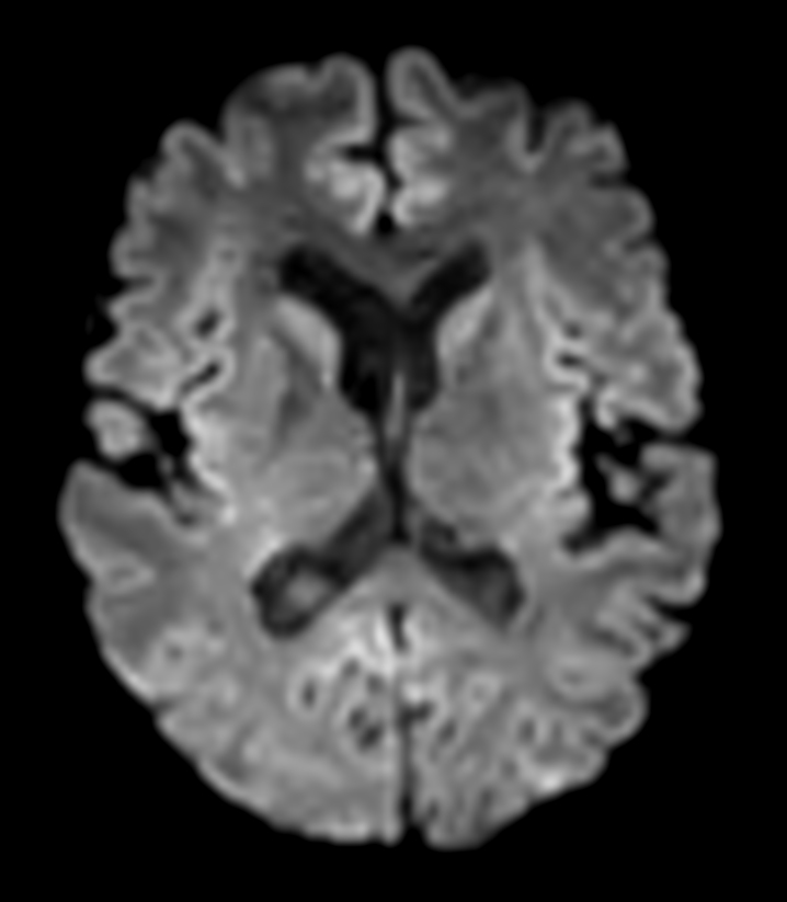 DTI b800 MultiBand SENSE 32 directions