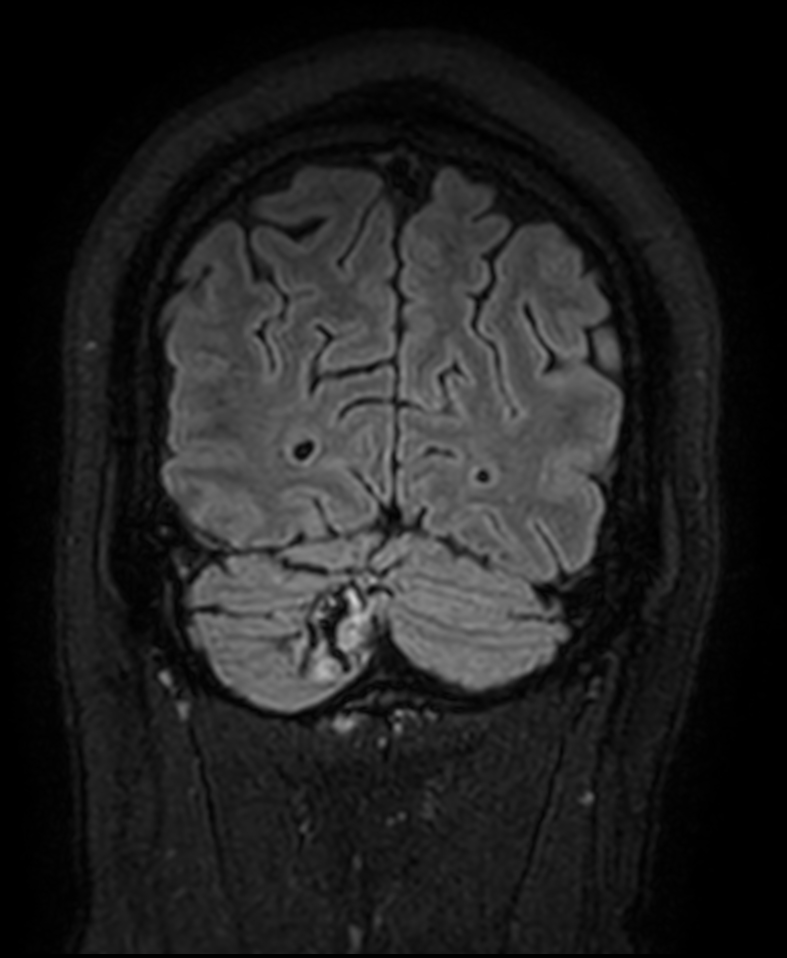 3D T2w FLAIR <b>Compressed SENSE</b>